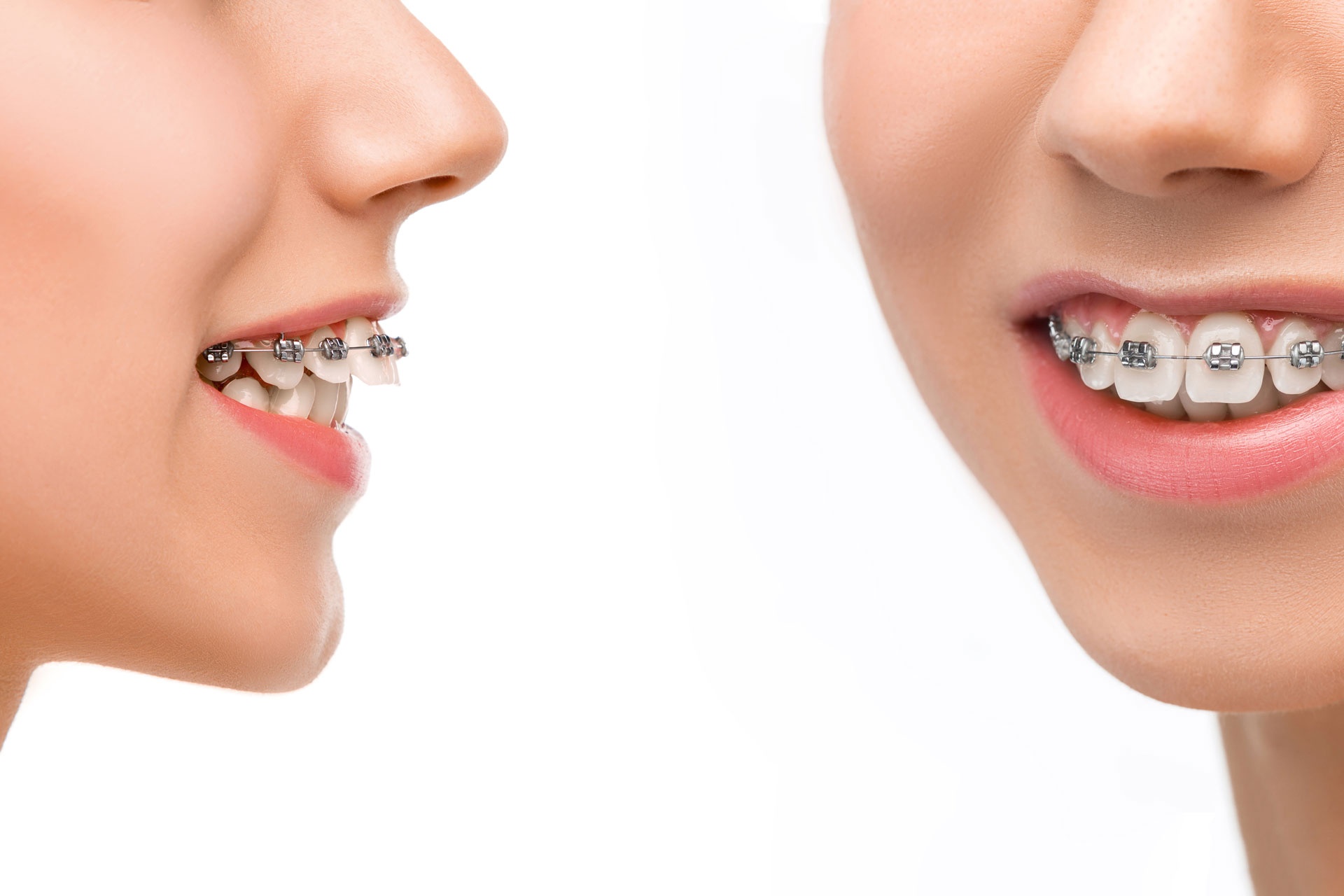 Overbite Vs Underbite: How To Recognize A Bite Issue